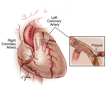 Left Coronary Artery Stenosis