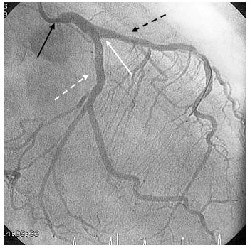 Left Main Coronary Artery Stenosis