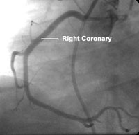 Right Coronary Artery Stenosis